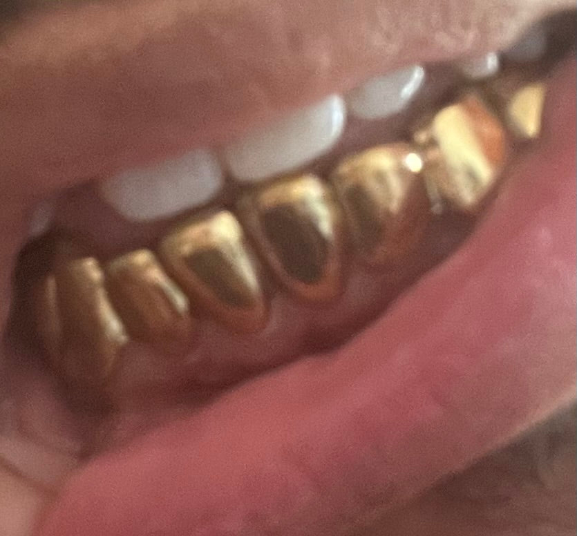 NPG Dental Gold Grillz Top Or Bottom Perm-Cut